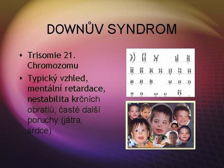 DOWNŮV SYNDROM s Trisomie 21. Chromozomu s Typický vzhled, mentální retardace, nestabilita krčních obratlů,