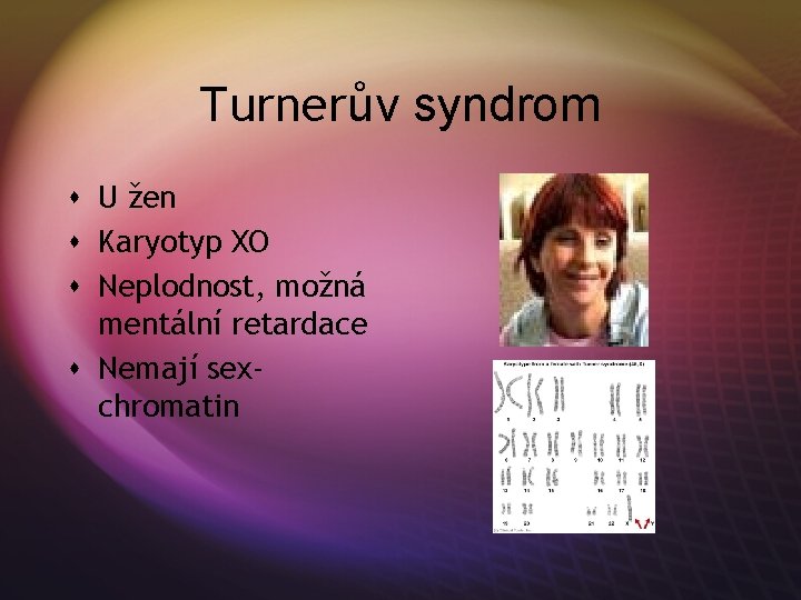 Turnerův syndrom s U žen s Karyotyp XO s Neplodnost, možná mentální retardace s