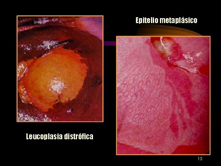 Epitelio metaplásico Leucoplasia distrófica 13 