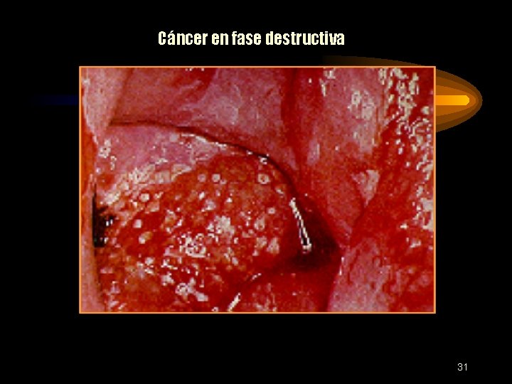 Cáncer en fase destructiva 31 