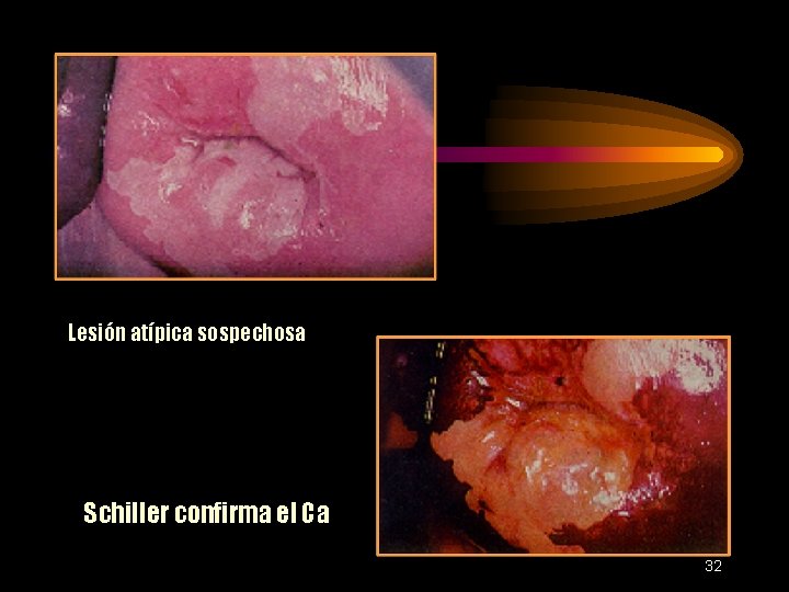 Lesión atípica sospechosa Schiller confirma el Ca 32 