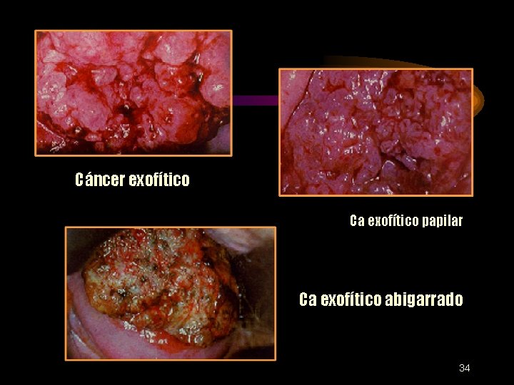 Cáncer exofítico Ca exofítico papilar Ca exofítico abigarrado 34 