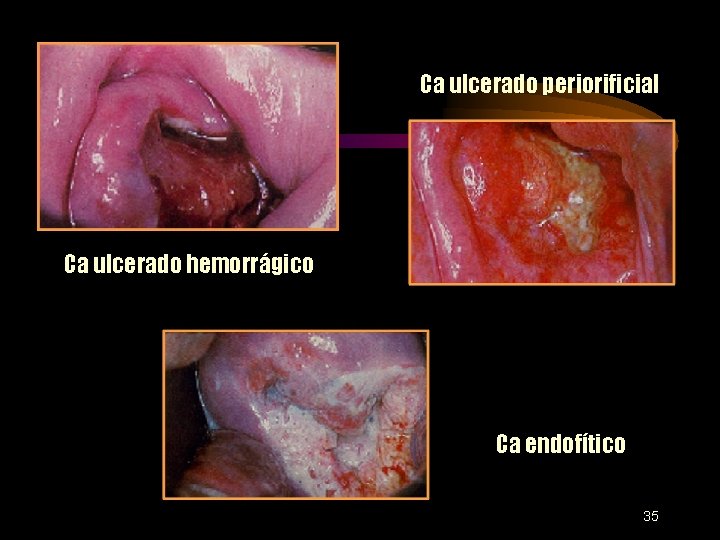 Ca ulcerado periorificial Ca ulcerado hemorrágico Ca endofítico 35 