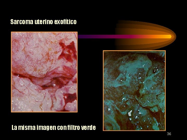 Sarcoma uterino exofítico La misma imagen con filtro verde 36 