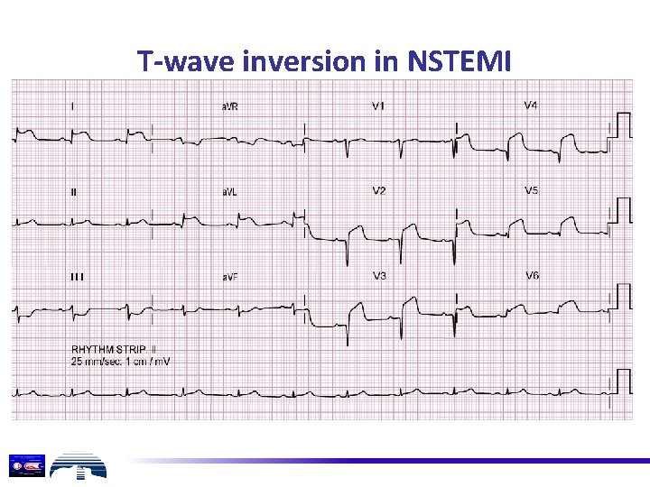 T-wave inversion in NSTEMI 