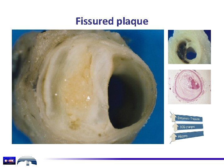 Fissured plaque 
