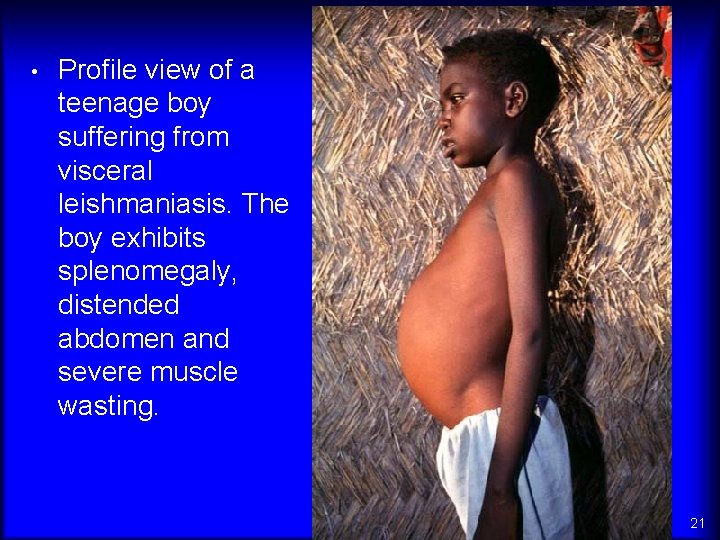  • Profile view of a teenage boy suffering from visceral leishmaniasis. The boy