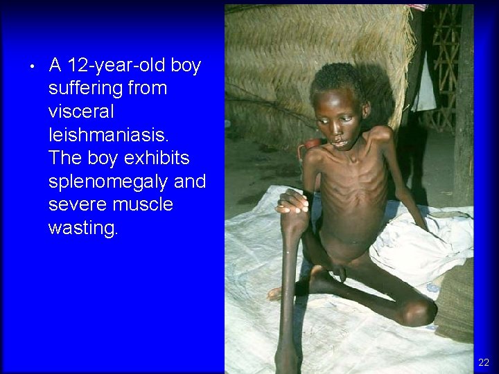  • A 12 -year-old boy suffering from visceral leishmaniasis. The boy exhibits splenomegaly