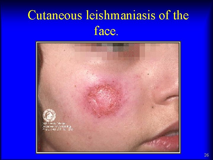 Cutaneous leishmaniasis of the face. 26 