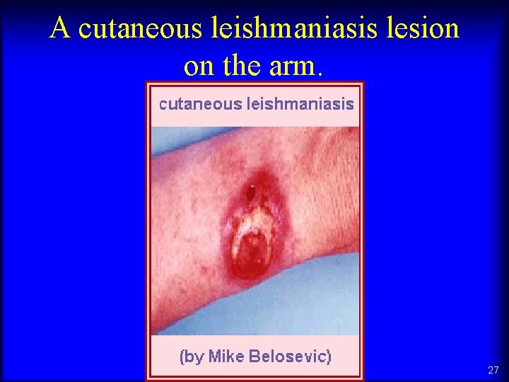 A cutaneous leishmaniasis lesion on the arm. 27 