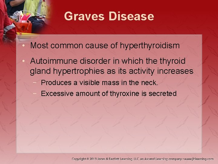 Graves Disease • Most common cause of hyperthyroidism • Autoimmune disorder in which the