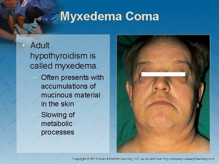 Myxedema Coma • Adult hypothyroidism is called myxedema. − Often presents with accumulations of