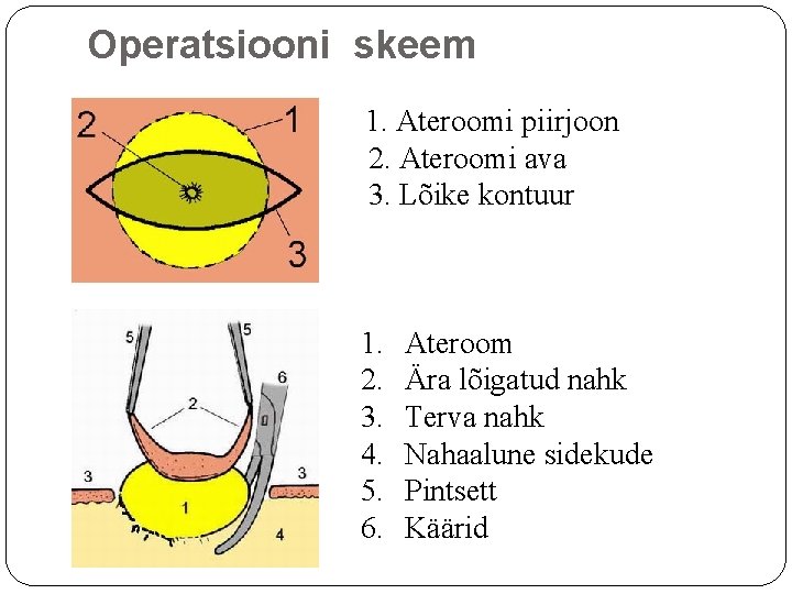 Operatsiooni skeem 1. Ateroomi piirjoon 2. Ateroomi ava 3. Lõike kontuur 1. 2. 3.