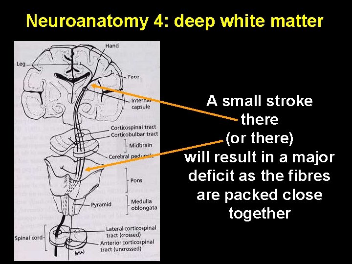 Neuroanatomy 4: deep white matter A small stroke there (or there) will result in