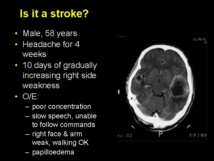 Is it a stroke? • Male, 58 years • Headache for 4 weeks •