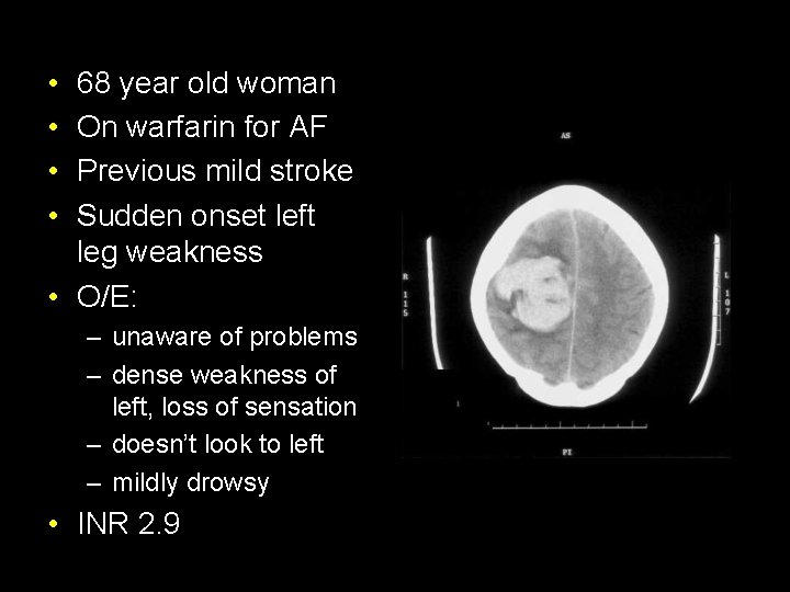  • • 68 year old woman On warfarin for AF Previous mild stroke