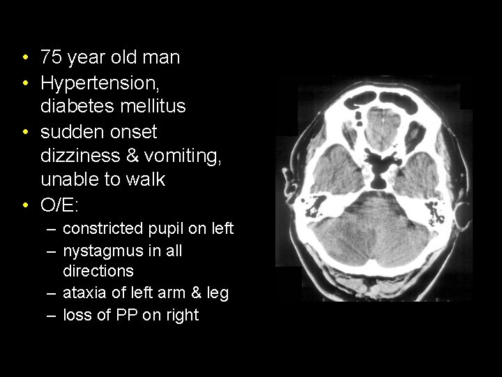 • 75 year old man • Hypertension, diabetes mellitus • sudden onset dizziness