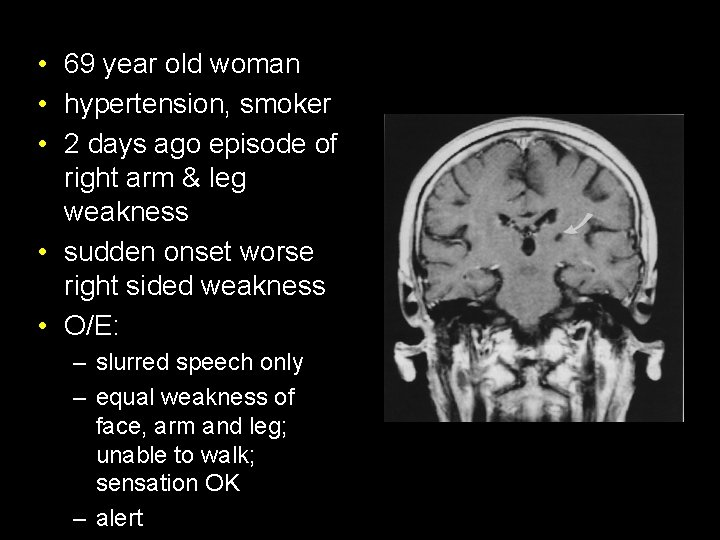  • 69 year old woman • hypertension, smoker • 2 days ago episode