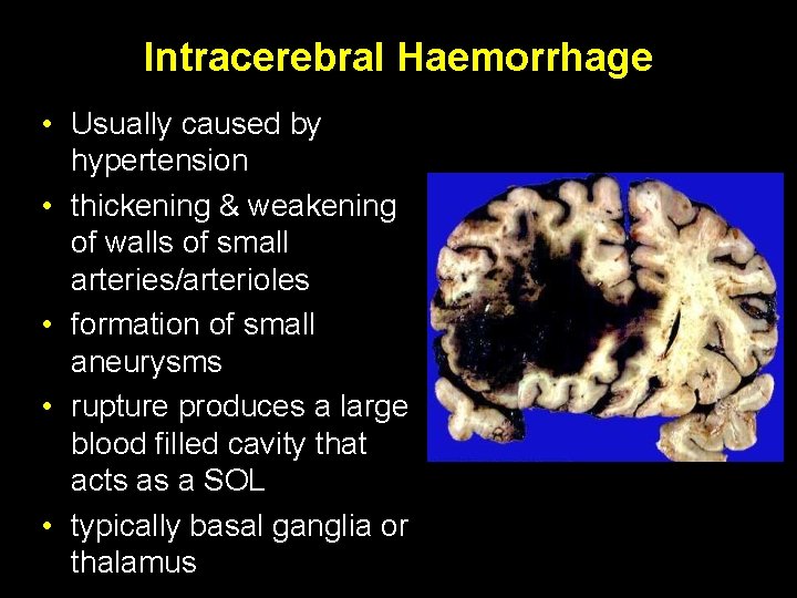 Intracerebral Haemorrhage • Usually caused by hypertension • thickening & weakening of walls of