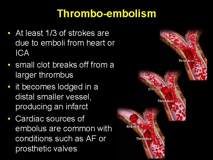 Thrombo-embolism • At least 1/3 of strokes are due to emboli from heart or