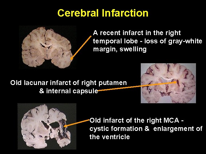 Cerebral Infarction A recent infarct in the right temporal lobe - loss of gray-white