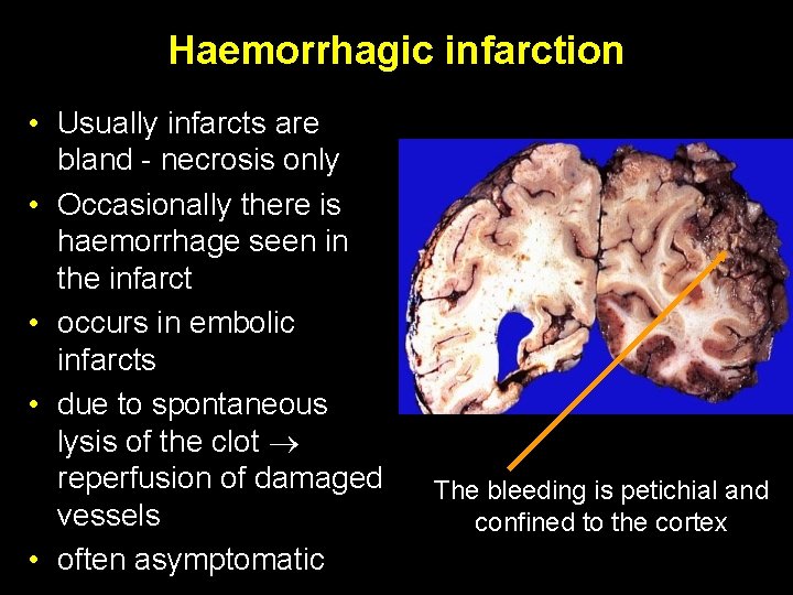 Haemorrhagic infarction • Usually infarcts are bland - necrosis only • Occasionally there is