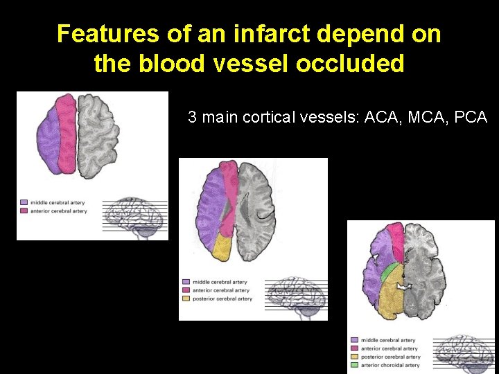 Features of an infarct depend on the blood vessel occluded 3 main cortical vessels: