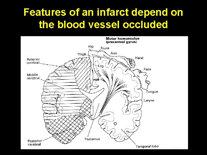 Features of an infarct depend on the blood vessel occluded 