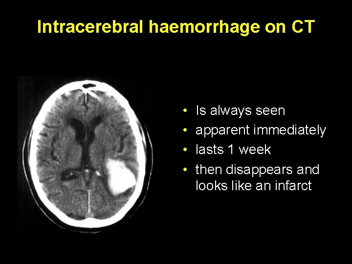Intracerebral haemorrhage on CT • • Is always seen apparent immediately lasts 1 week