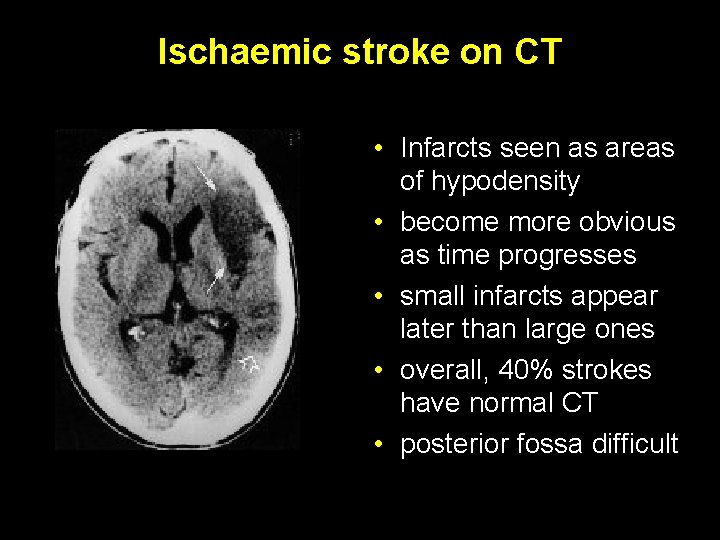 Ischaemic stroke on CT • Infarcts seen as areas of hypodensity • become more