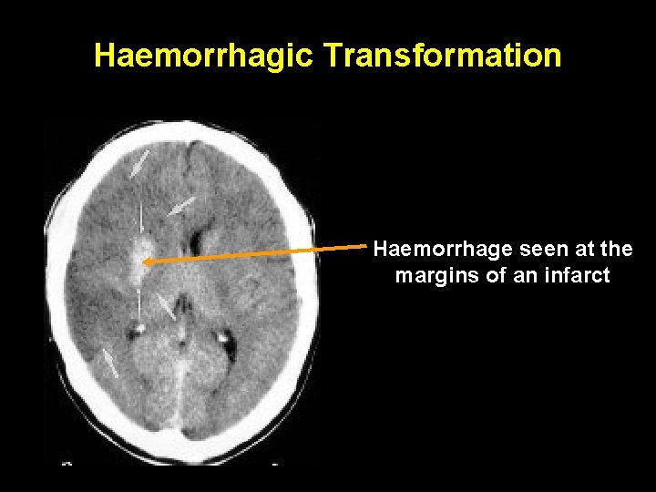 Haemorrhagic Transformation Haemorrhage seen at the margins of an infarct 