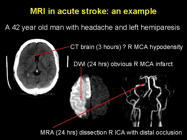 MRI in acute stroke: an example A 42 year old man with headache and