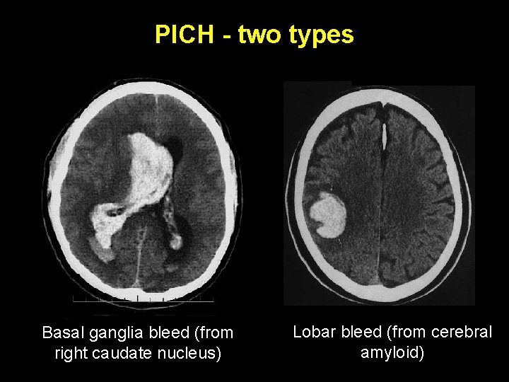 PICH - two types Basal ganglia bleed (from right caudate nucleus) Lobar bleed (from