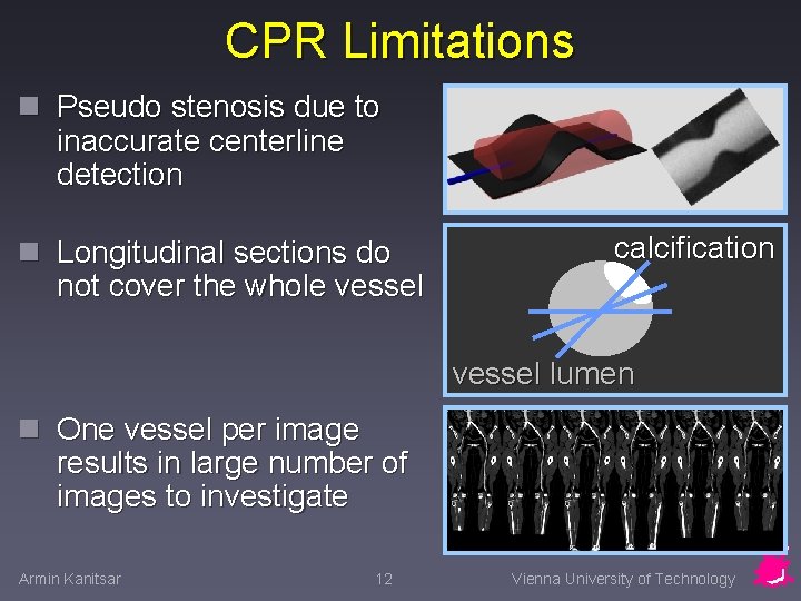 CPR Limitations n Pseudo stenosis due to inaccurate centerline detection n Longitudinal sections do