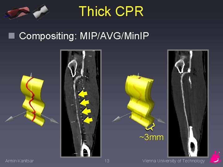 Thick CPR n Compositing: MIP/AVG/Min. IP ~3 mm Armin Kanitsar 13 Vienna University of