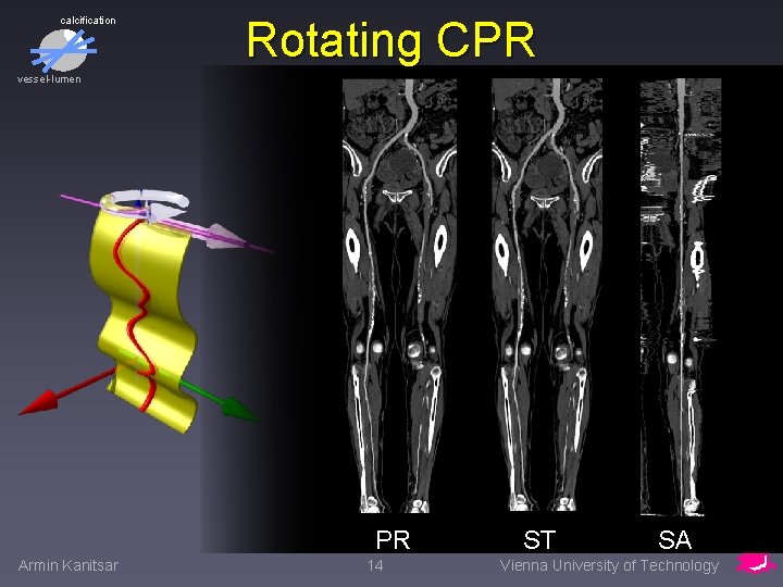 calcification Rotating CPR vessel-lumen PR Armin Kanitsar 14 ST SA Vienna University of Technology