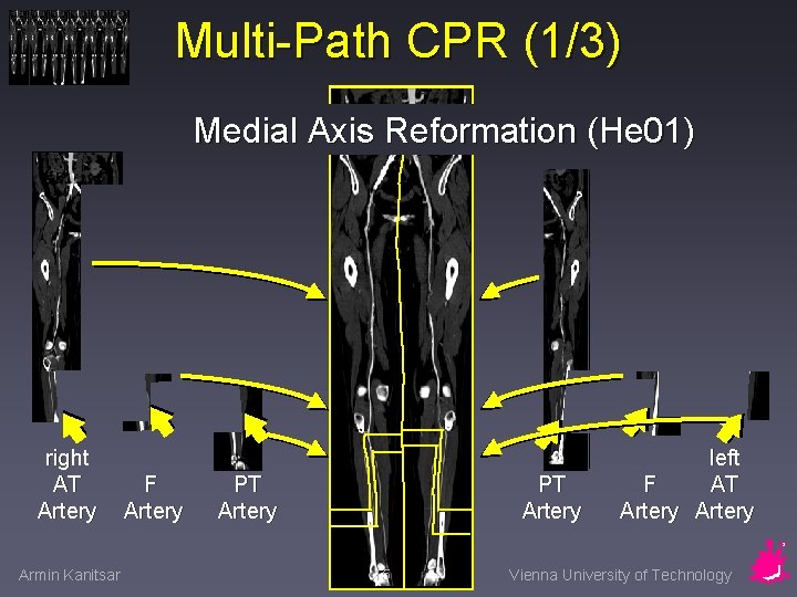 Multi-Path CPR (1/3) Medial Axis Reformation (He 01) right AT Artery Armin Kanitsar F