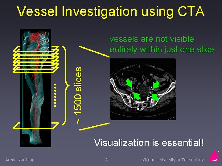Vessel Investigation using CTA ~ 1500 slices vessels are not visible entirely within just