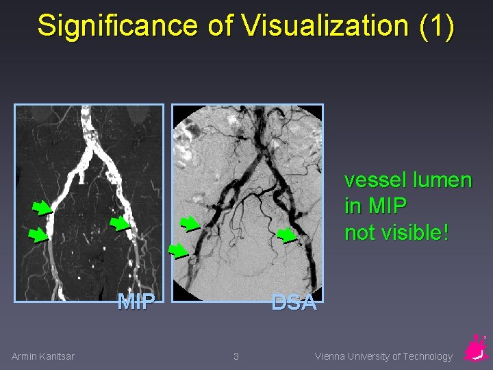 Significance of Visualization (1) vessel lumen in MIP not visible! MIP Armin Kanitsar DSA