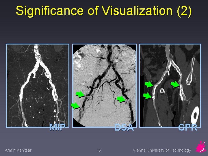 Significance of Visualization (2) MIP Armin Kanitsar DSA 5 CPR Vienna University of Technology