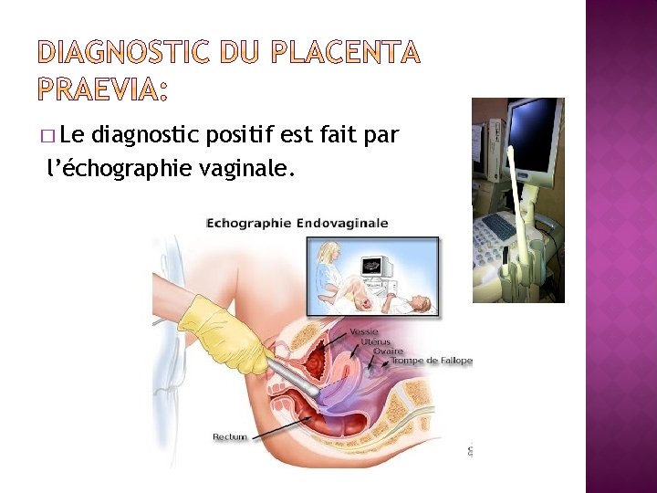 � Le diagnostic positif est fait par l’échographie vaginale. 