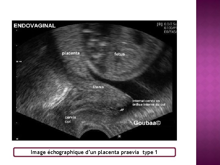 Image échographique d’un placenta praevia type 1 