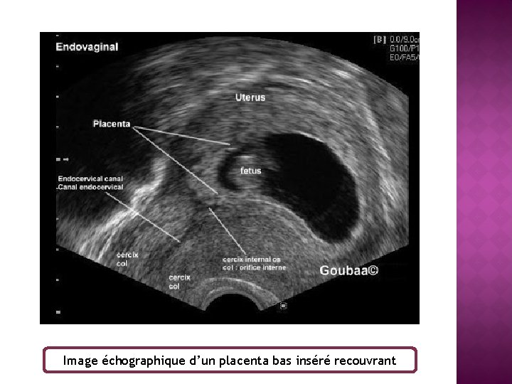 Image échographique d’un placenta bas inséré recouvrant 