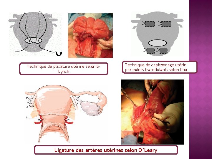 Technique de plicature utérine selon BLynch Technique de capitonnage utérin par points transfixiants selon