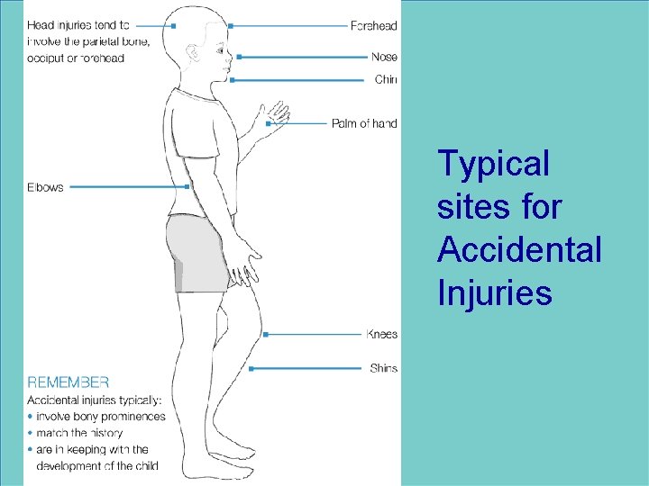 Typical sites for Accidental Injuries 