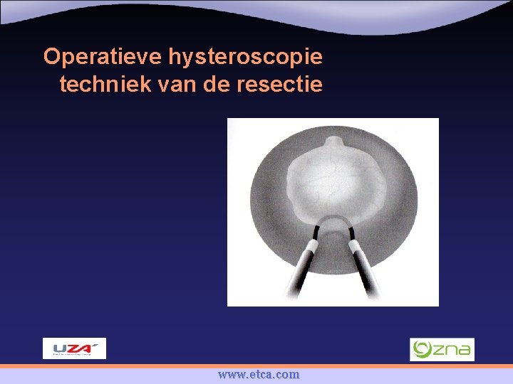 Operatieve hysteroscopie techniek van de resectie www. etca. com 