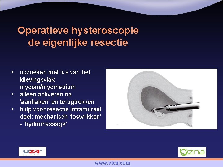 Operatieve hysteroscopie de eigenlijke resectie • opzoeken met lus van het klievingsvlak myoom/myometrium •