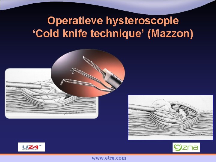 Operatieve hysteroscopie ‘Cold knife technique’ (Mazzon) www. etca. com 