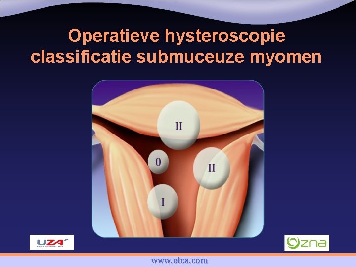 Operatieve hysteroscopie classificatie submuceuze myomen www. etca. com 