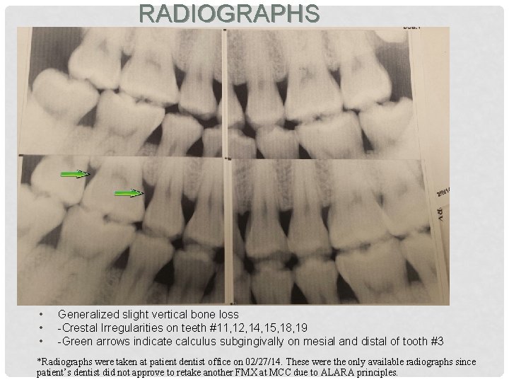 RADIOGRAPHS • • • Generalized slight vertical bone loss -Crestal Irregularities on teeth #11,